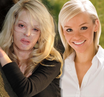 Katie Piper Before R and After L The 26 year old recalls the memory 